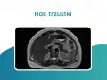 Przekrój rezonansu magnetycznego jamy brzusznej pokazujący obraz raka trzustki. Badania te są kluczowe w diagnostyce.