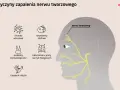 Ilustracja przedstawia przyczyny zapalenia nerwu twarzowego: choroby wirusowe, nowotwory, problemy stomatologiczne, zaburzenia naczyń mózgowych i zapalenie mięśni.