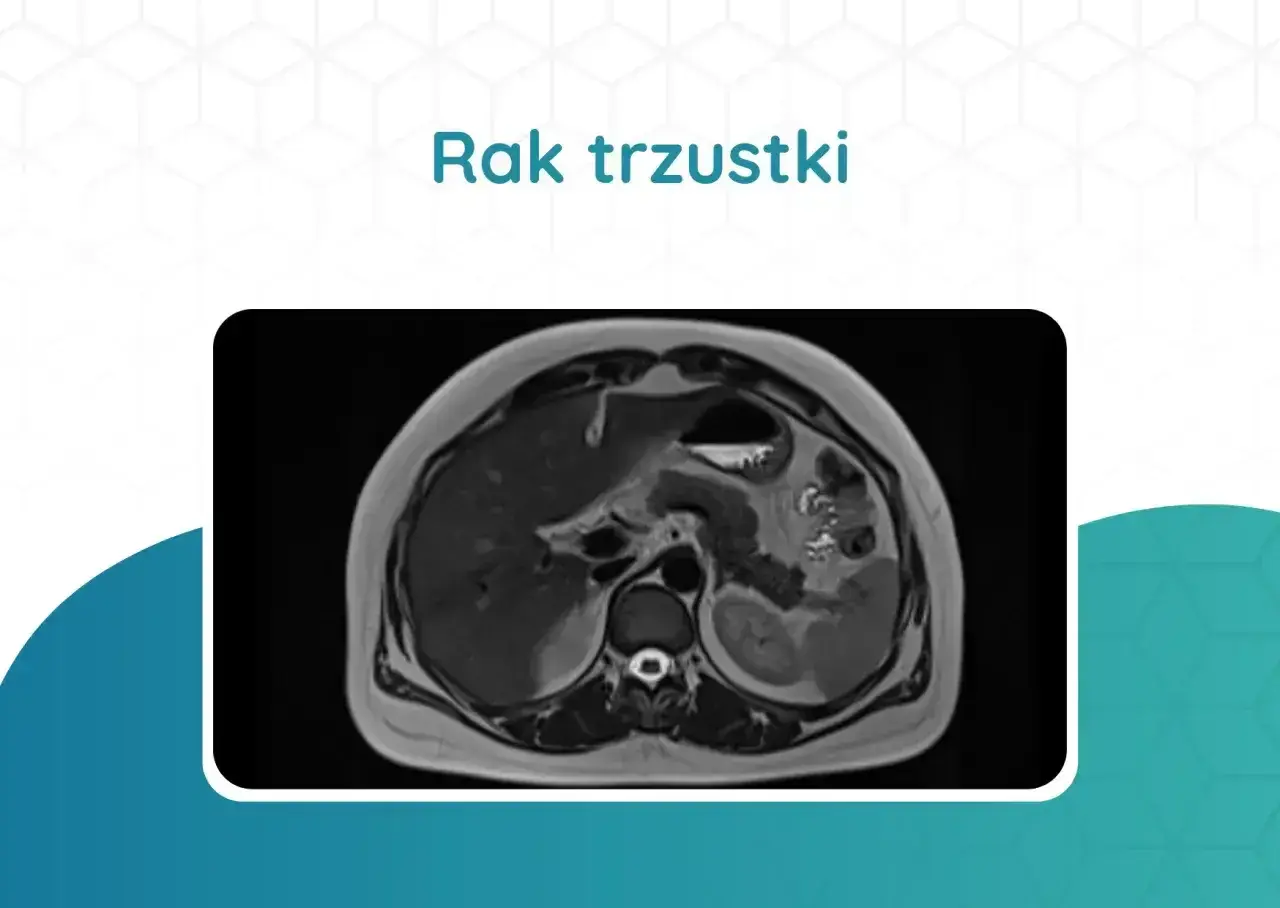 Przekrój rezonansu magnetycznego jamy brzusznej pokazujący obraz raka trzustki. Badania te są kluczowe w diagnostyce.