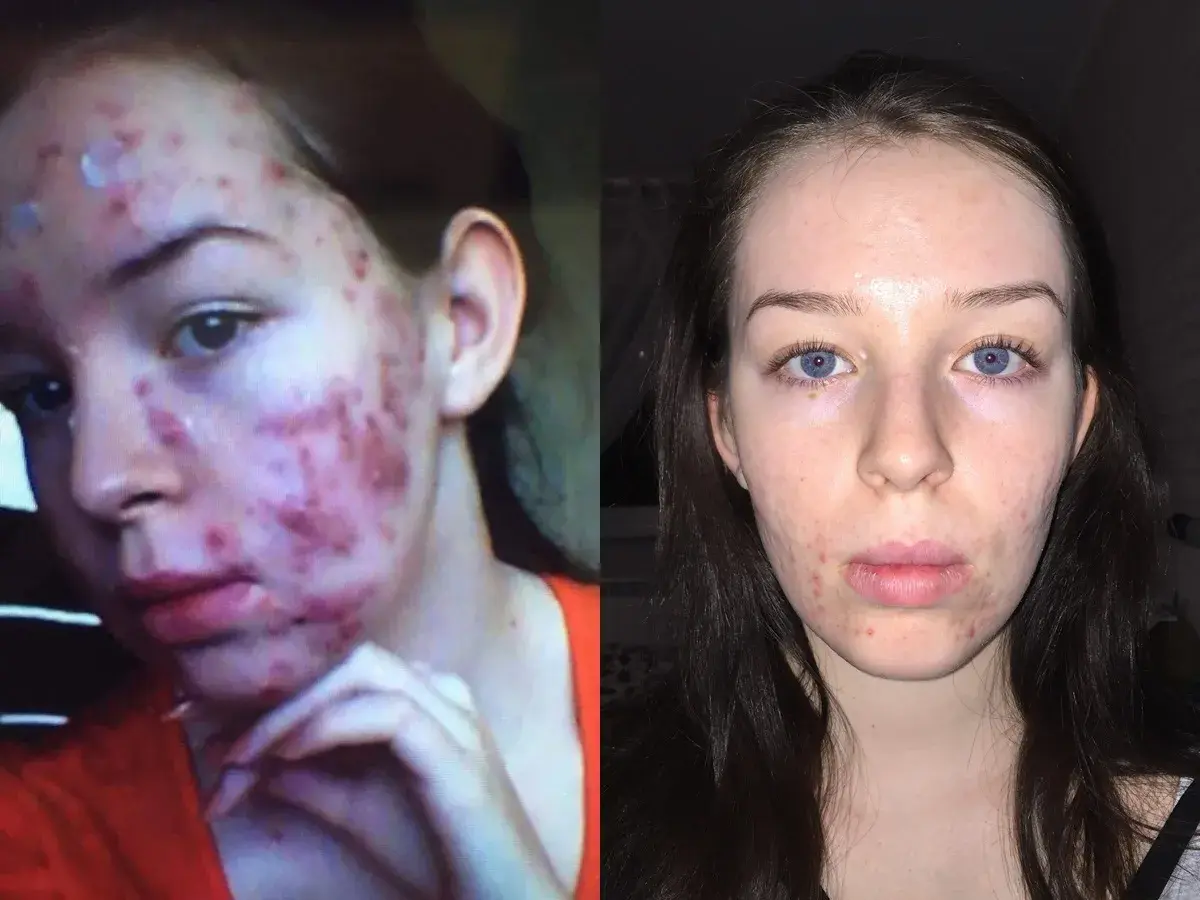 Przed i po leczeniu izotretynoiną. Widoczna poprawa stanu cery, zmniejszenie trądziku.