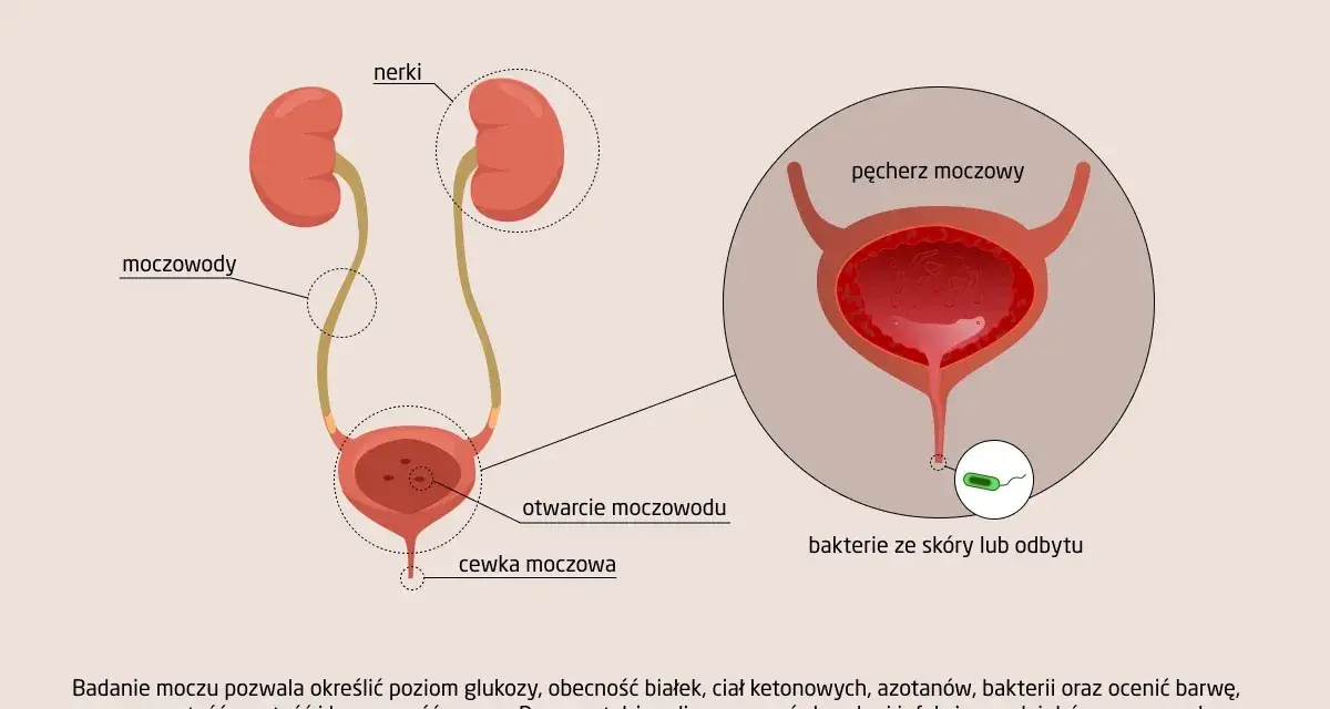 Ilustracja układu moczowego z zaznaczonymi nerkami, moczowodami i pęcherzem. W powiększeniu widoczne bakterie w moczu.
