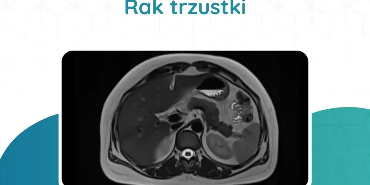 Przekrój rezonansu magnetycznego jamy brzusznej pokazujący obraz raka trzustki. Badania te są kluczowe w diagnostyce.