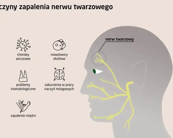 Ilustracja przedstawia przyczyny zapalenia nerwu twarzowego: choroby wirusowe, nowotwory, problemy stomatologiczne, zaburzenia naczyń mózgowych i zapalenie mięśni.