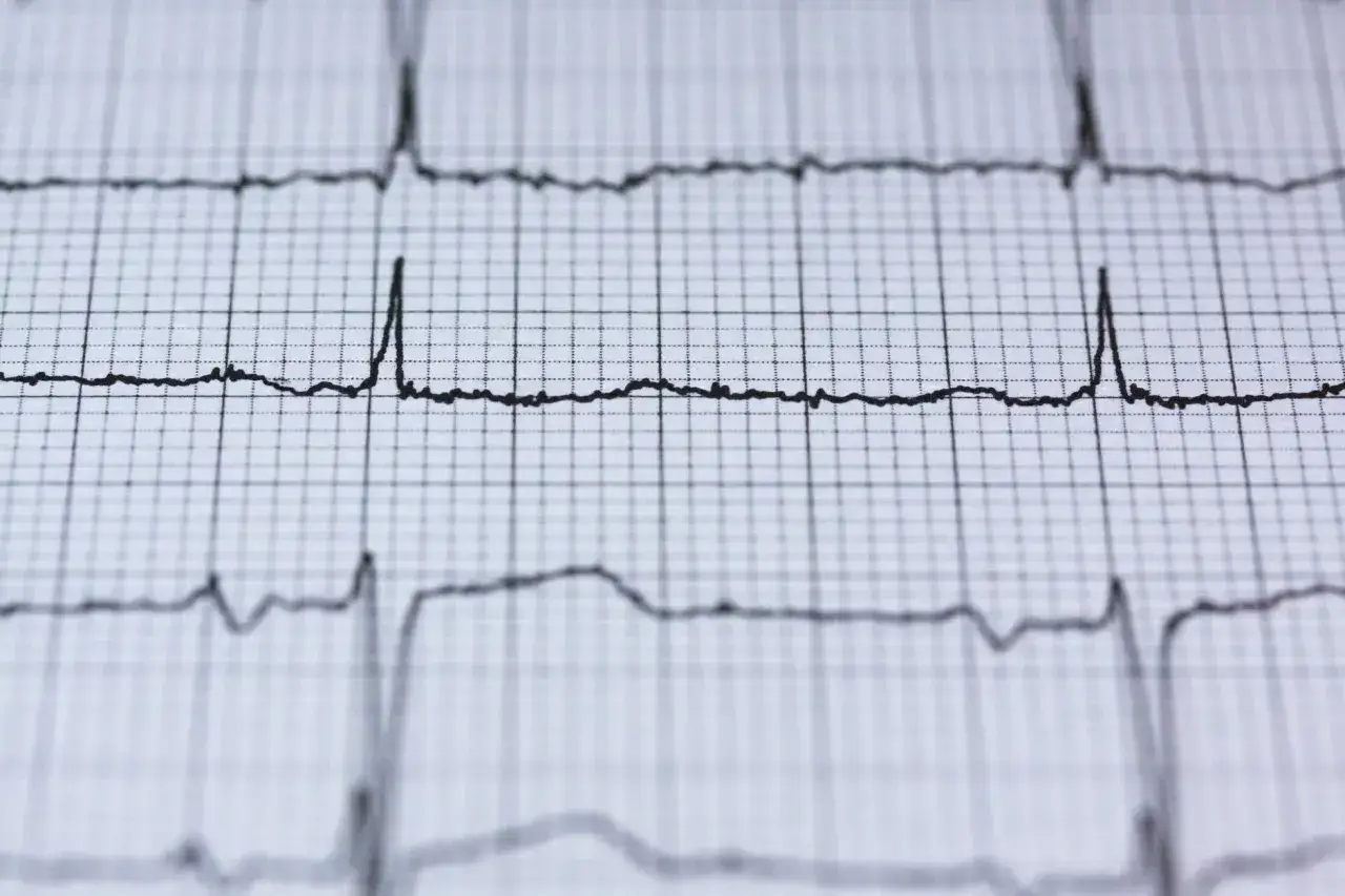 EKG z widocznymi liniami serca. Czy nerwica serca wyjdzie na EKG? Zapis pokazuje rytm serca, ale nie zawsze odzwierciedla nerwicę.